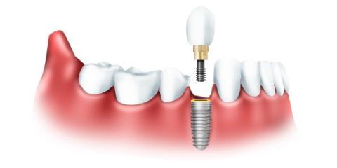 Имплантация зубов: возможные осложнения после операции