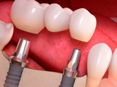 Особенности имплантации зубов в iStomatolog Киева