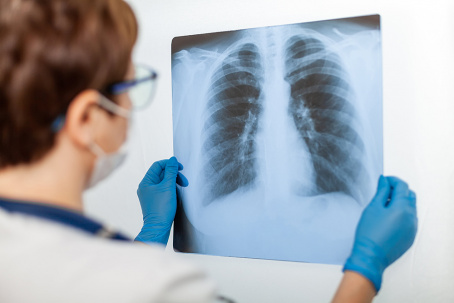 Сколько стоит рентген-обследование органов грудной клетки в Дружковке?